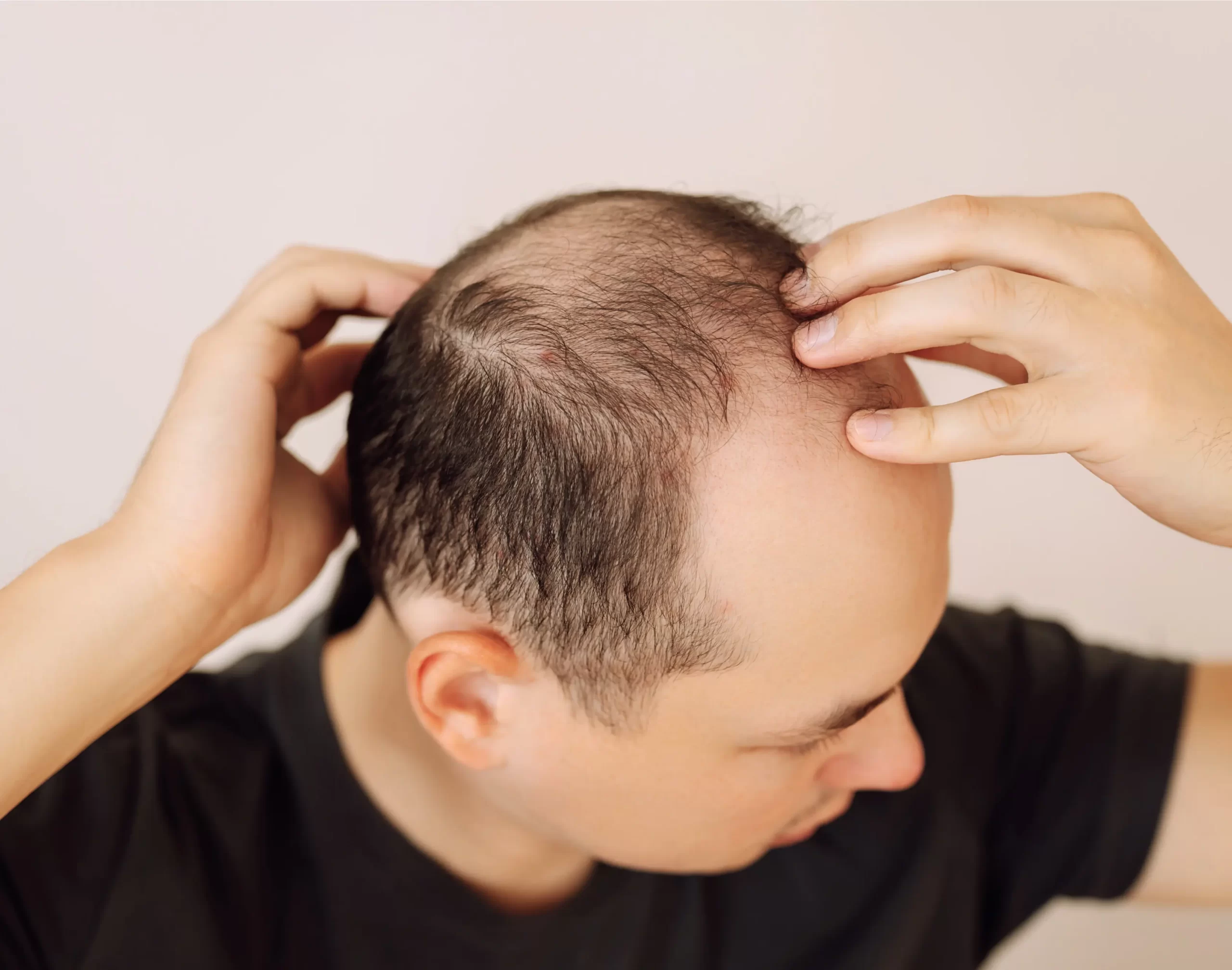 Hair Loss Treatment